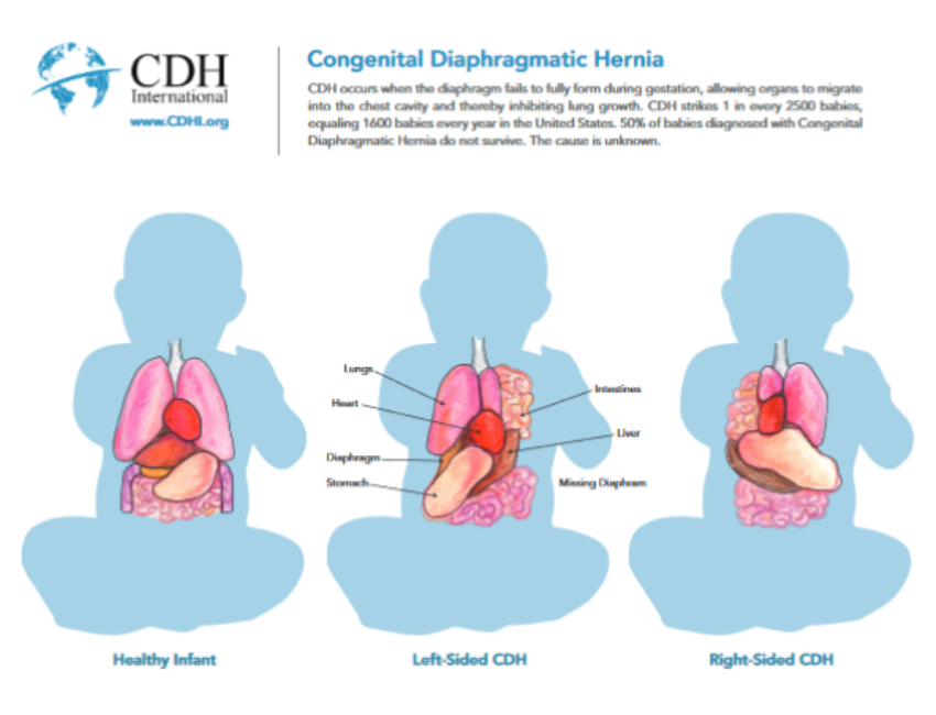 Donate to CDH Research