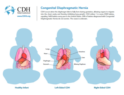 Donate to CDH Research