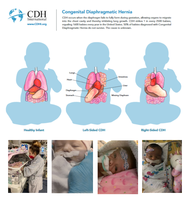 Donate now to Fight Congenital Diaphragmatic Hernia and help kids like Braden